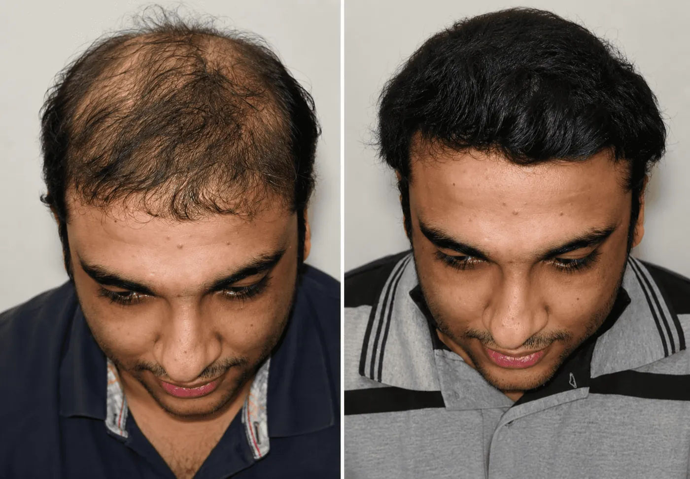 Before and after transformation at Image Clinic