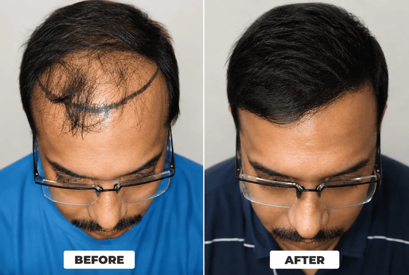 Before and after transformation at Image Clinic